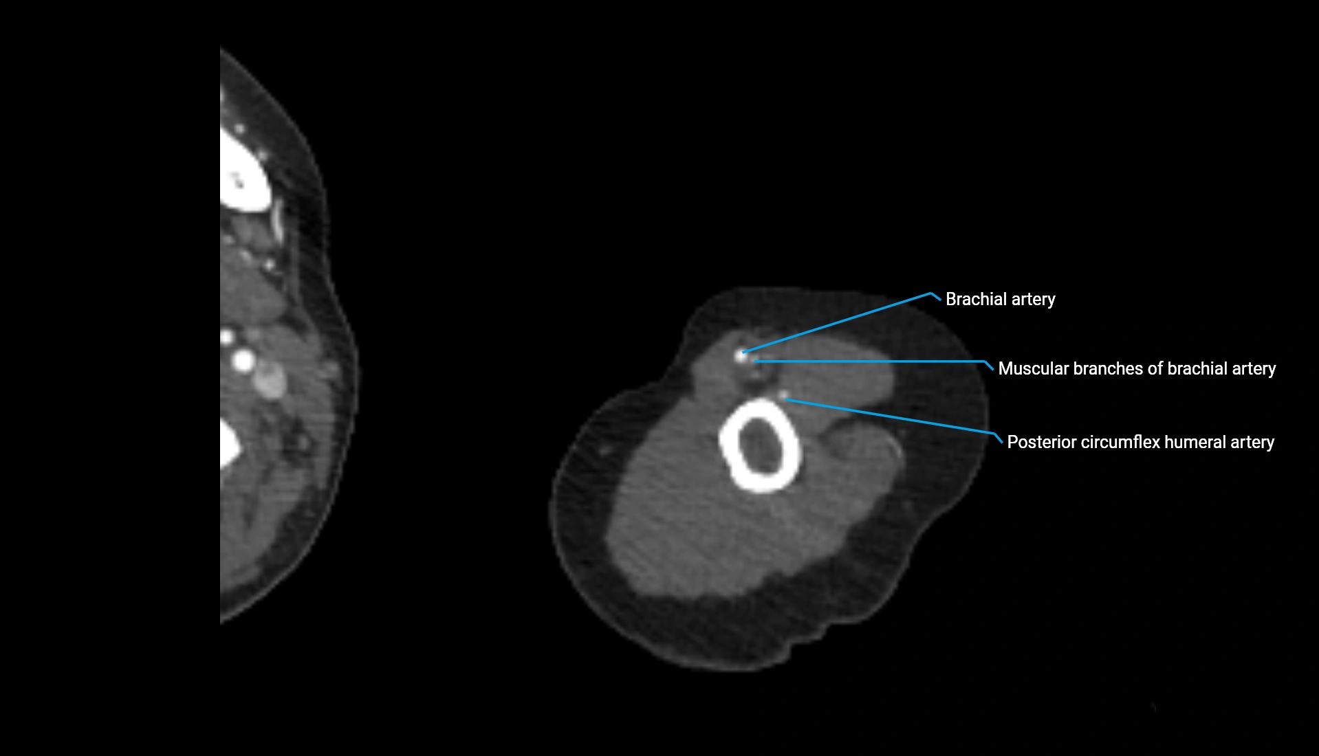 CTA upper limb axial cross sectional anatomy labelled image 296 (2).webp
